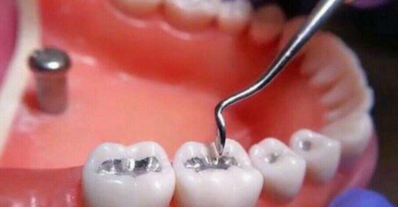 آمالگام تهدیدی جدی برای سلامتی بیماران و دندانپزشکان