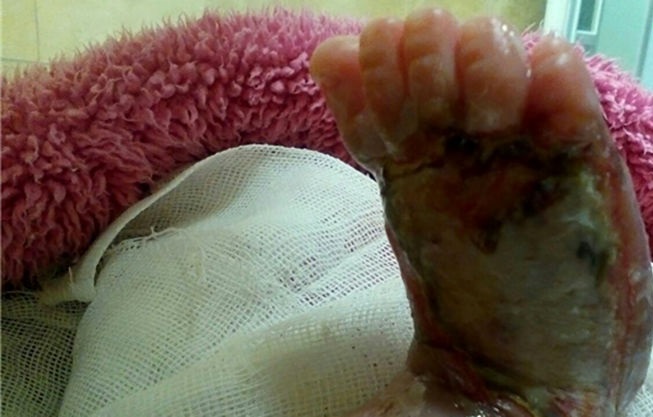 سوختگی پای نوزاد ۶ روزه با تزریق اشتباه در بیمارستان امام خمینی + تصاویر