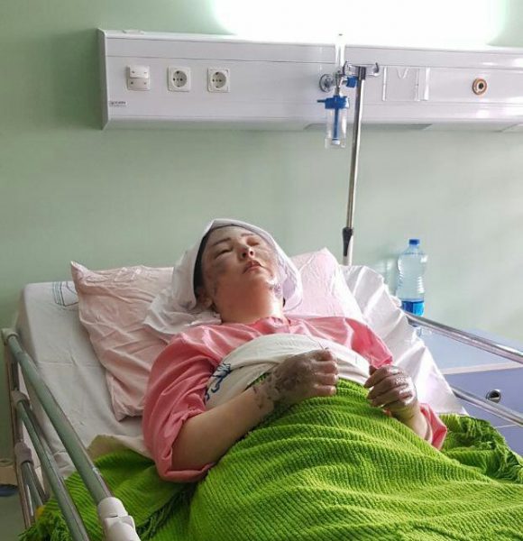 آخرین وضعیت درمانی دومین قربانی اسیدپاشی در تبریز/ ۱۵ درصد سوختگی درجه ۲ و ۳